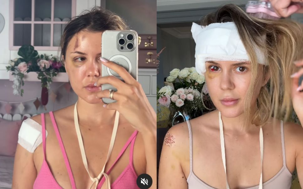 Semnificația panglicii pe care Emily Burghelea o poartă în fiecare zi la gât, de când a fost la doar un pas de a-și pierde viața, în urma accidentului rutier din Mauritius: „Am multă recunoștință”